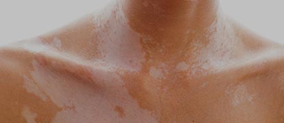 autoimmune spezialeffekte